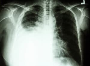 pleural effusion due to lung cancer